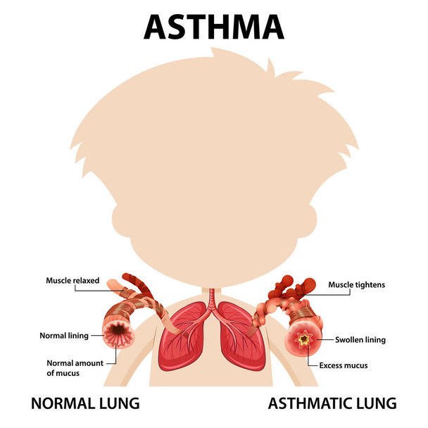 Bronchialis asztma diagram normál tüdő és asztmás tüdő illusztráció - Vektor, kép