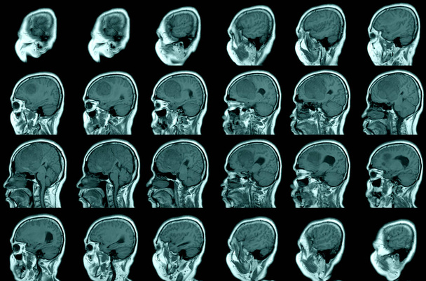 MRI BRAIN Sagittal views FINDINGS: Η μελέτη αποκαλύπτει μια καλά οριοθετημένη, εξωαξονική μάζα, που προκύπτει από τον πρόσθιο φαλό cerebri, που εκτείνεται σε διμερείς μετωπικές περιοχές, με παρακείμενο ελάχιστο περιστασιακό οίδημα στους αριστερούς μετωπιαίους λοβούς - Φωτογραφία, εικόνα