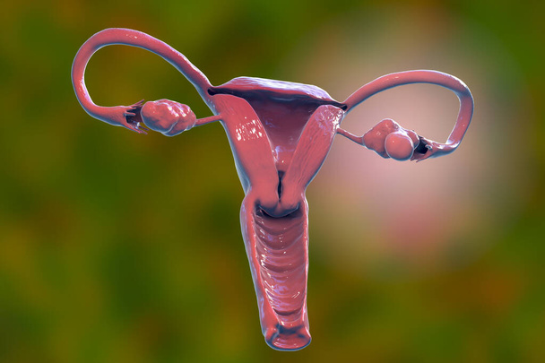 Синдром поликистозных яичников, 3D иллюстрация, показывающая увеличенный левый яичник с кистами - Фото, изображение