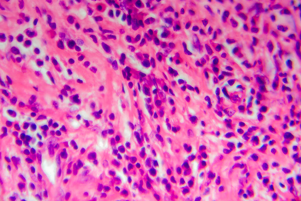 Linfoma de Hodgkin, micrografía ligera, foto bajo el microscopio. Es un tipo de linfoma en el que el cáncer se origina a partir de linfocitos. - Foto, Imagen