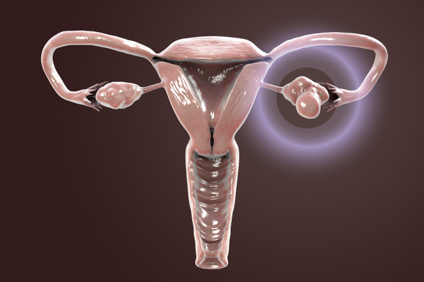 Синдром поликистозных яичников, 3D иллюстрация здорового яичника (справа) и увеличенного яичника с кистами (слева)) - Фото, изображение