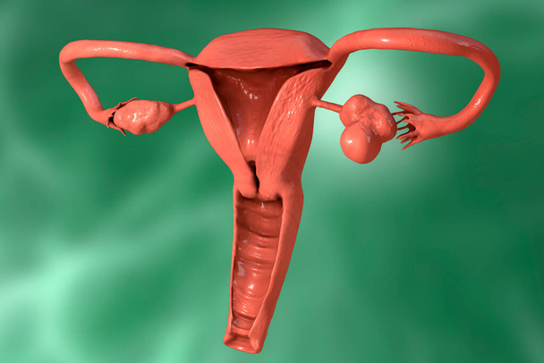 Polycystic ovary syndrome, 3D illustration showing enlarged left ovary with cysts - Φωτογραφία, εικόνα