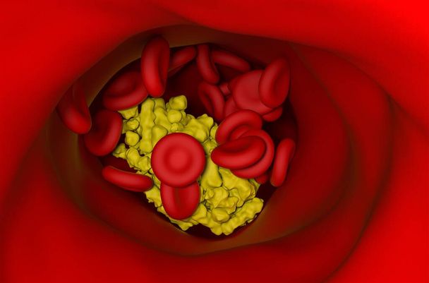 Extra high level of cholesterol crystals make barrier on a clogged artery wall to the red blood cells move 3d  - Photo, Image