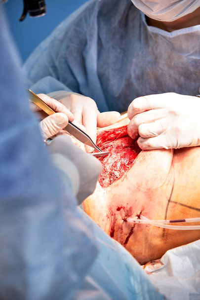 El médico realiza una operación para reconstruir la mama femenina. Primer plano del cirujano plástico que realiza el procedimiento de implantación, cáncer de mama. - Foto, imagen