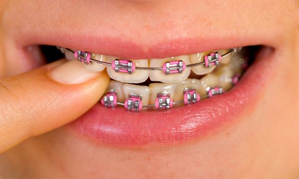 Pink braces - 写真・画像