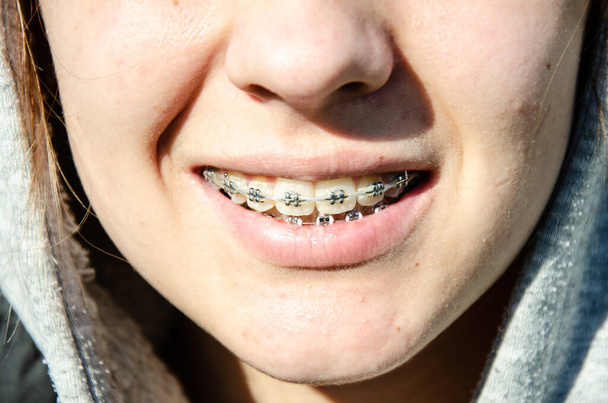 Conception d'accolades sur les dents. Belle jeune fille caucasienne dans les appareils dentaires sourit au soleil. Concept d'adolescence. Peau problématique avec acné. Adolescents pendant la puberté. - Photo, image