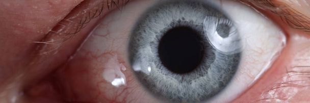 Primer plano del ojo enfermo con vasos rojos dilatados - Foto, Imagen