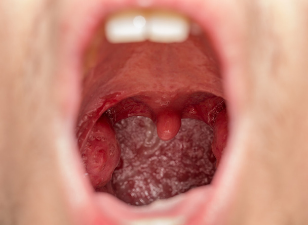 Vue bouche ouverte des amygdales
 - Photo, image