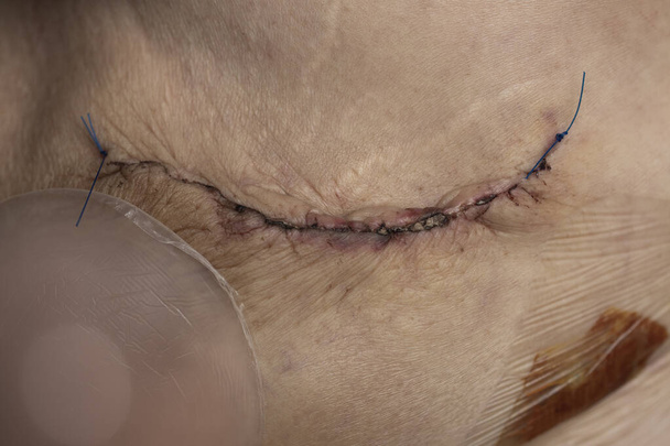 乳がんによる乳房切除後の傷跡 - 写真・画像
