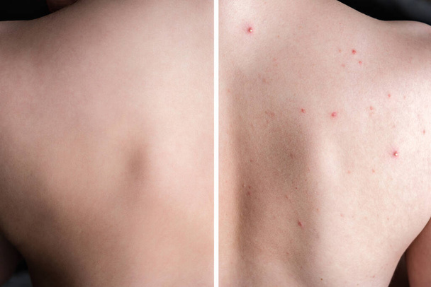 Πριν και μετά τη θεραπεία σπυράκια ακμής στην πλάτη του δέρματος του εφήβου. - Φωτογραφία, εικόνα