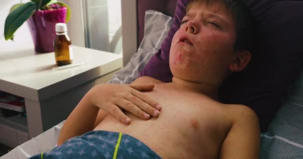 Viruserkrankungen. Masern-Ausschlag. Kind mit Virusinfektion Masern liegt im Bett und kratzt sich - Filmmaterial, Video