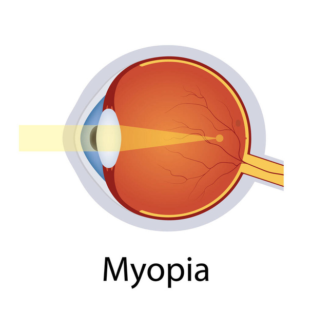 Miopia e disturbi della vista Illustrazione. Concetto di difetto degli occhi. Dettagliato bulbo oculare anatomico con difetto di miopia. Vettore isolato - Vettoriali, immagini