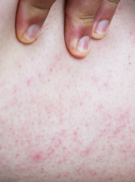 Acne of stekelige warmte of huiduitslag op gevoelige huid, Red dot groep op roze kleur oppervlak, Symptomen van warm weer en allergisch zweet - Foto, afbeelding