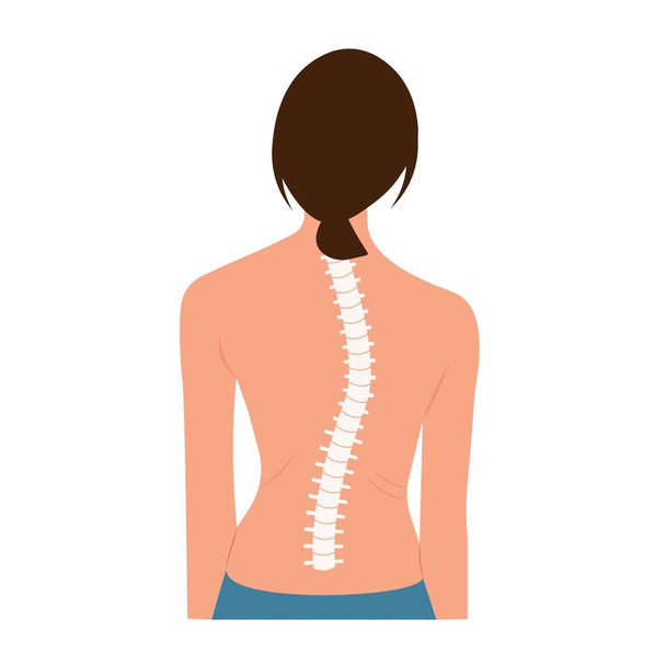 Scoliosis Spine Curve Anatomy, διόρθωση θέσης. Χειροπρακτική θεραπεία. Εικονογράφηση διάνυσμα της πίσω όψη γυναίκα που αντιπροσωπεύει σκολίωση και κλίμακα καμπυλότητας - Διάνυσμα, εικόνα