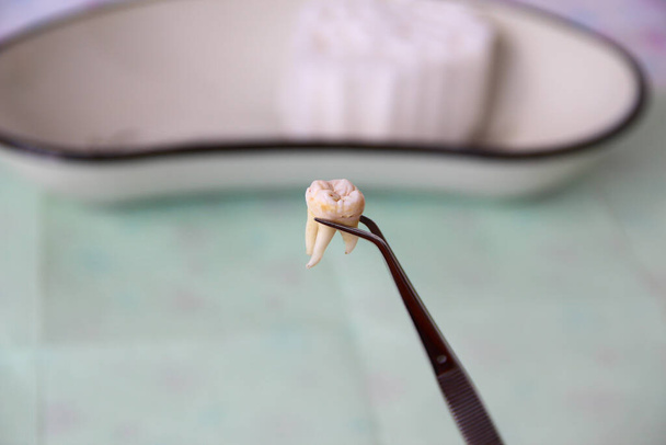 Витягнутий зуб у пінцеті в кабінеті стоматолога
 - Фото, зображення
