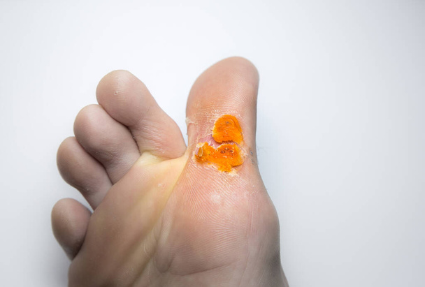 Contagious skin illness on foot. Medical treatment photo - Photo, Image