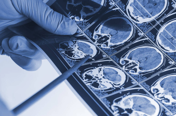 Neurochirurg zeigt Punkt einer Röntgenaufnahme des menschlichen Gehirns mit - Foto, Bild