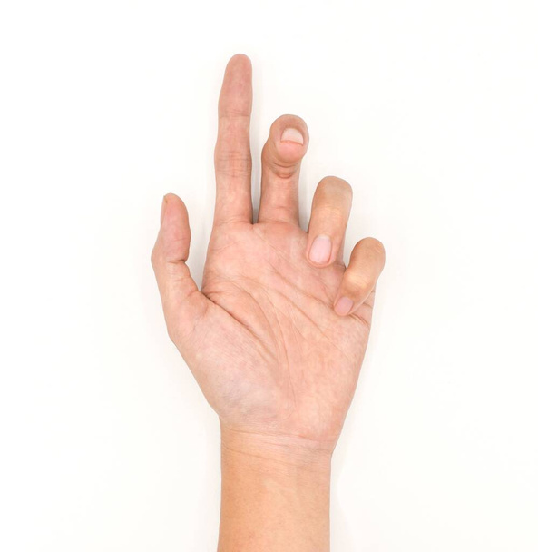 Ulnar Klauenhand eines asiatischen jungen Mannes. auch als "Spinsterkralle" bekannt. entwickelt sich aufgrund einer Ulnarnervenschädigung, die eine Lähmung der Lendenwirbelsäule verursacht - Foto, Bild