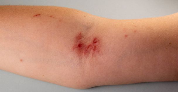 grass burn Borshchevik Heracleum, injury on the arm, skin damage. - 写真・画像