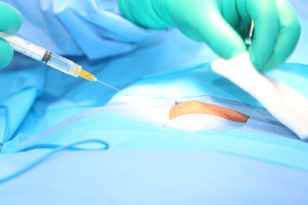 Doctor putting anesthesia in an open wound.  Focus in the open w - Photo, Image