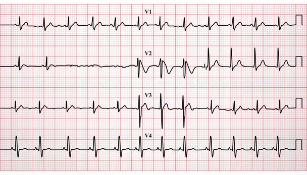 Electrocardiograma, ECG, latidos cardíacos en formato vectorial - Vector, imagen