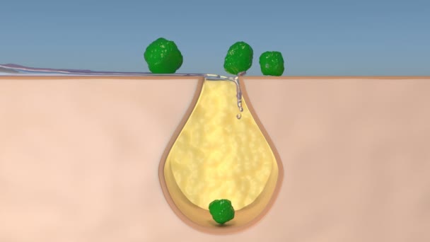 Capa de la piel Limpieza del agua Arruga suavizar el efecto de reparación del acné. bacteria de lodo delato - Metraje, vídeo