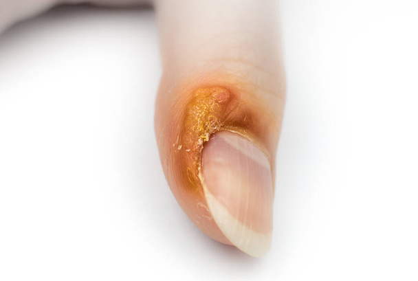 Cierra Wart en el dedo. Enfermedad cutánea contagiosa en la mano de la mujer. Tratamiento médico, macro foto. - Foto, imagen