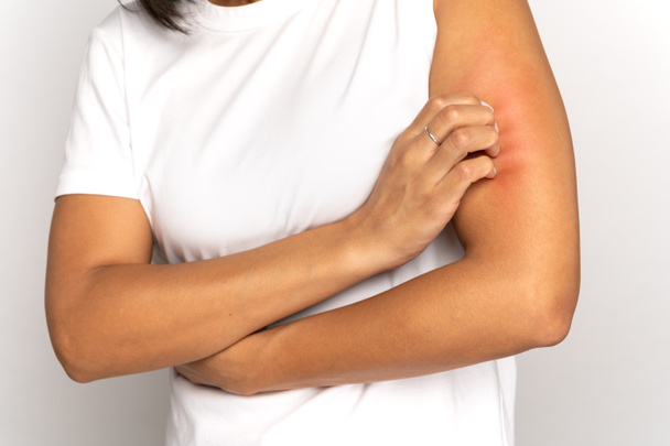 Mädchen kratzen an der Hand, leiden unter trockener Haut oder Juckreiz, Tierallergie, Insektenstichen. Studio - Foto, Bild