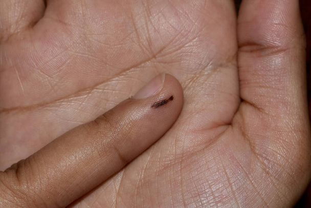 Nevus oblongo en forma de dedo de mujer joven asiática. Marca de nacimiento. - Foto, Imagen