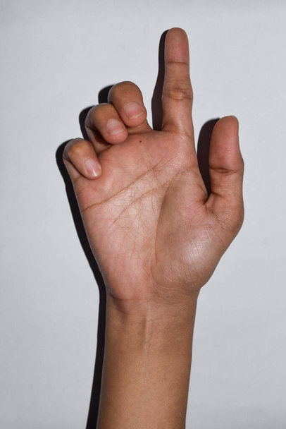 La mano de garra de Ulnar de la joven asiática. también conocida como "garra de solterona". se desarrolla debido al daño del nervio cubital que causa parálisis de los lumbrales. - Foto, imagen
