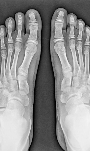Röntgen menschlicher Füße. Ansicht von oben. - Foto, Bild