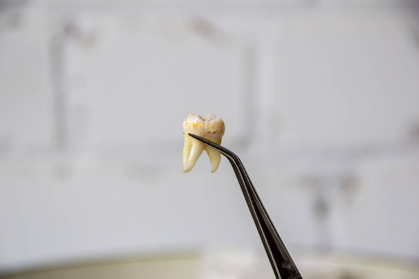 Diente extraído en pinzas en el consultorio de un dentista - Foto, Imagen