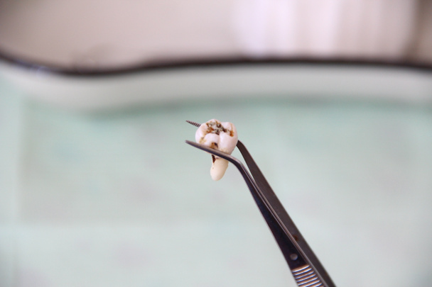 Вырезанный зуб в пинцете на фоне стоматологического подноса - Фото, изображение