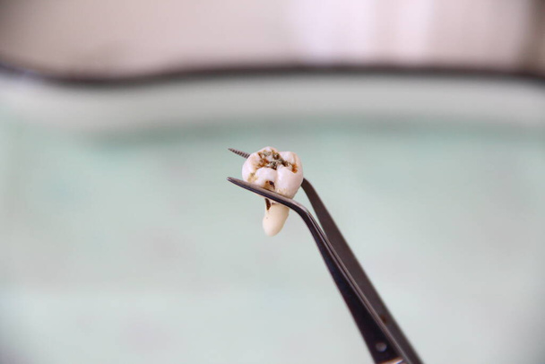 Витягнутий зуб у пінцеті на тлі зубного лотка
 - Фото, зображення