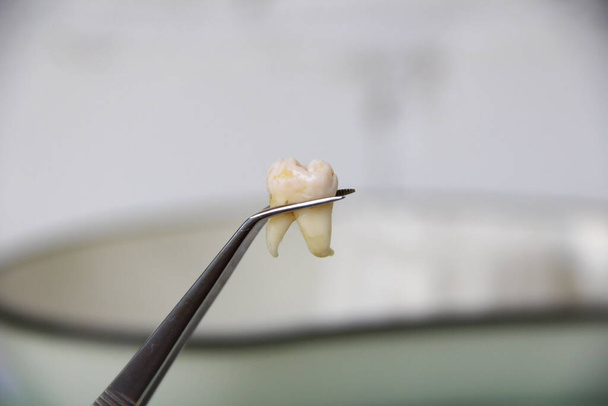 Витягнутий зуб у пінцеті на тлі зубного лотка
 - Фото, зображення