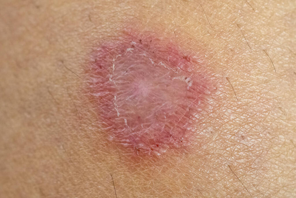 Infecção da pele causada pelo molde. - Foto, Imagem