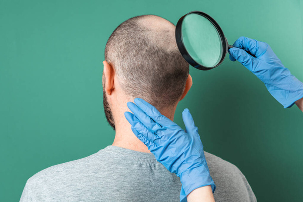 A trikológus nagyítóval vizsgálja a kopaszság területét az ügyfél fején. Visszanézni. Zöld háttér. Az alopecia és az esztétikai orvoslás fogalma. - Fotó, kép