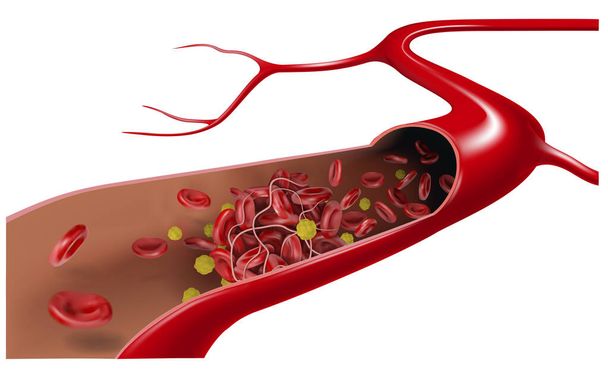 Dans la veine, le cholestérol coule avec les érythrocytes et forme un caillot sanguin. Illustration vectorielle 3D - Vecteur, image