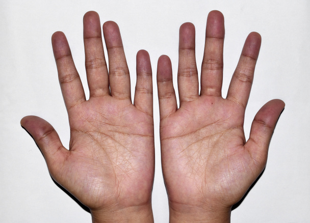 Cyanotyczne dłonie lub sinica obwodowa lub niebieskie dłonie w Azji Południowo-Wschodniej, chińska młoda kobieta z wrodzoną chorobą serca. - Zdjęcie, obraz