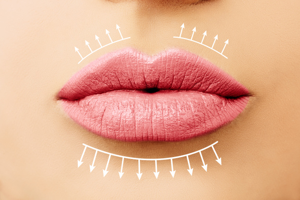 Des lèvres roses. Lèvres féminines avant et après les injections de remplissage des lèvres. Augmentation des lèvres - Photo, image