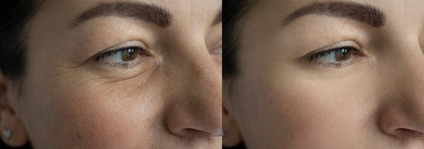 vrouw ogen rimpels voor en na de behandeling - Foto, afbeelding