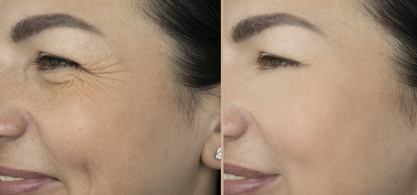 vrouw ogen rimpels voor en na de behandeling - Foto, afbeelding