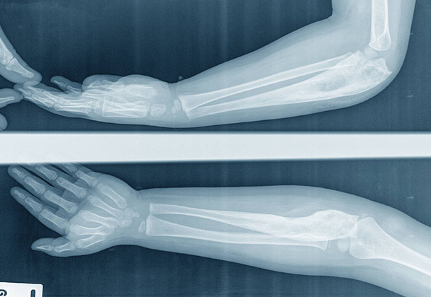 Coude radiographique pour enfants Vue latérale de l'avant-bras causée par le cancer de l'os (ostéosarcome) de l'ulna. Isolé sur noir - Photo, image