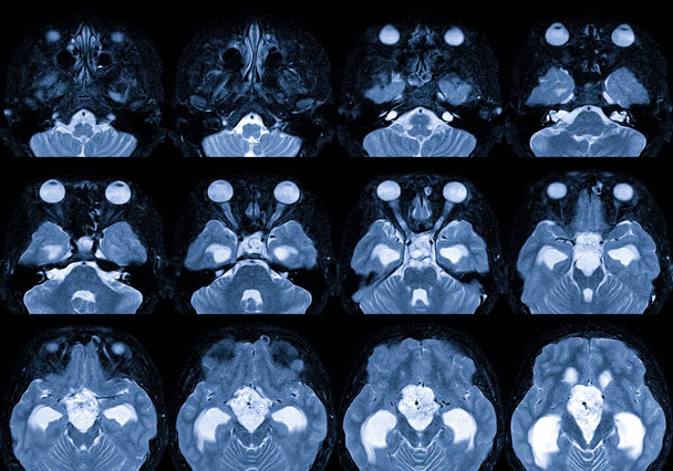 MRI Hersenen met contrastmiddelen Bevinding: Er is een 3,5 cm diameter gelobbyde massa bij suprasellar met compressie van de hypofyse, Medische gezondheidszorg concept. - Foto, afbeelding