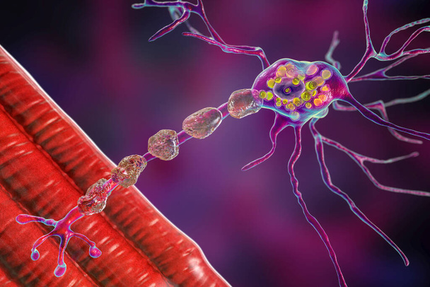 Нейроны мозга при болезни Тай-Сакса, 3D иллюстрация, показывающая распухшие нейроны с мембранными пластинчатыми включениями из-за накопления ганглиозидов в лизосомах и демиелинизации - Фото, изображение