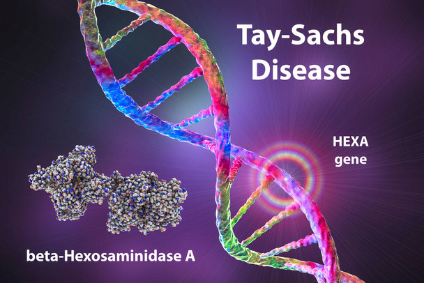 Tay-Sachs-Krankheit, 3D-Illustration. Eine genetische Störung, die Gehirnneuronen nach und nach zerstört, wird durch eine genetische Mutation im HEXA-Gen verursacht, die zu einem Mangel des Enzyms Hexosaminidase A führt - Foto, Bild