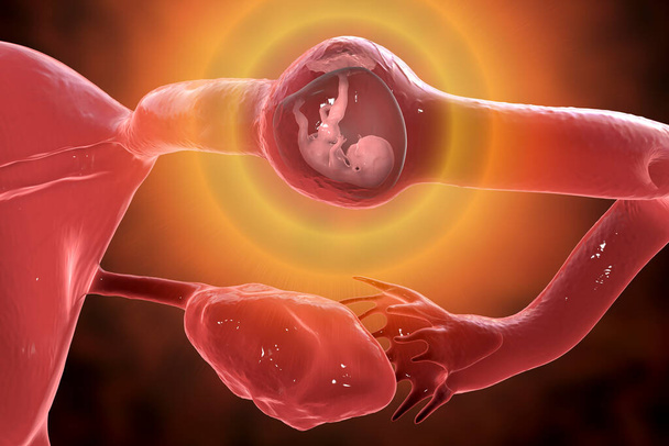 Eileiterschwangerschaft, 3D-Illustration, die einen 8-wöchigen menschlichen Fötus zeigt, der in die Eileiter statt in die Gebärmutter implantiert wird - Foto, Bild