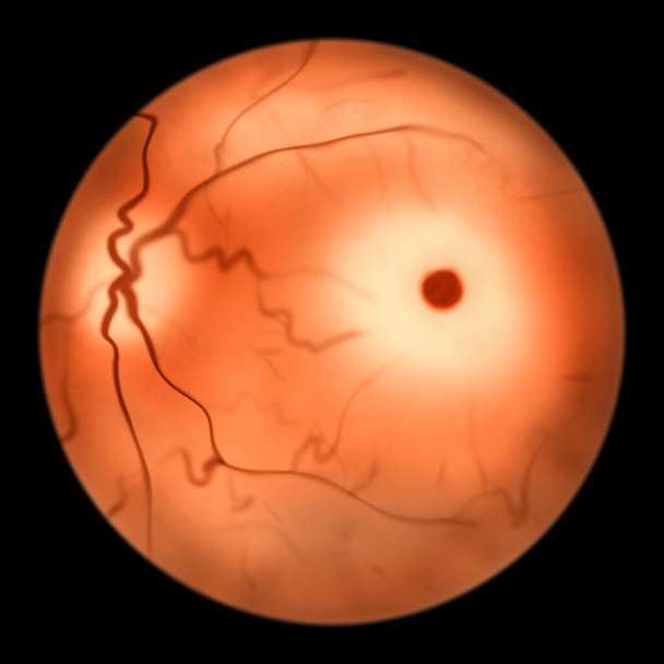 Глазная сетчатка при заболеваниях сфинголипидного хранения, 3D иллюстрация. Макулярная вишневая красная точка. Болезнь Тея - Сакса и болезнь Нимана Пика - Фото, изображение