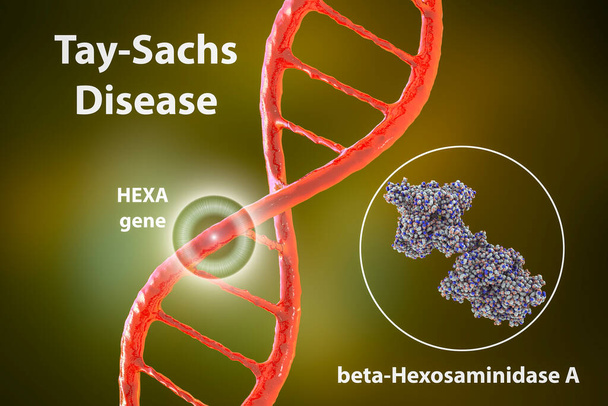 Tay-Sachs-Krankheit, 3D-Illustration. Eine genetische Störung, die Gehirnneuronen nach und nach zerstört, wird durch eine genetische Mutation im HEXA-Gen verursacht, die zu einem Mangel des Enzyms Hexosaminidase A führt - Foto, Bild