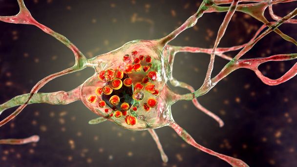 Hirnneuronen bei der Tay-Sachs-Krankheit, 3D-Illustration zeigt geschwollene Neuronen mit membranförmigen lamellären Einschlüssen aufgrund der Akkumulation von Gangliosiden in Lysosomen - Foto, Bild